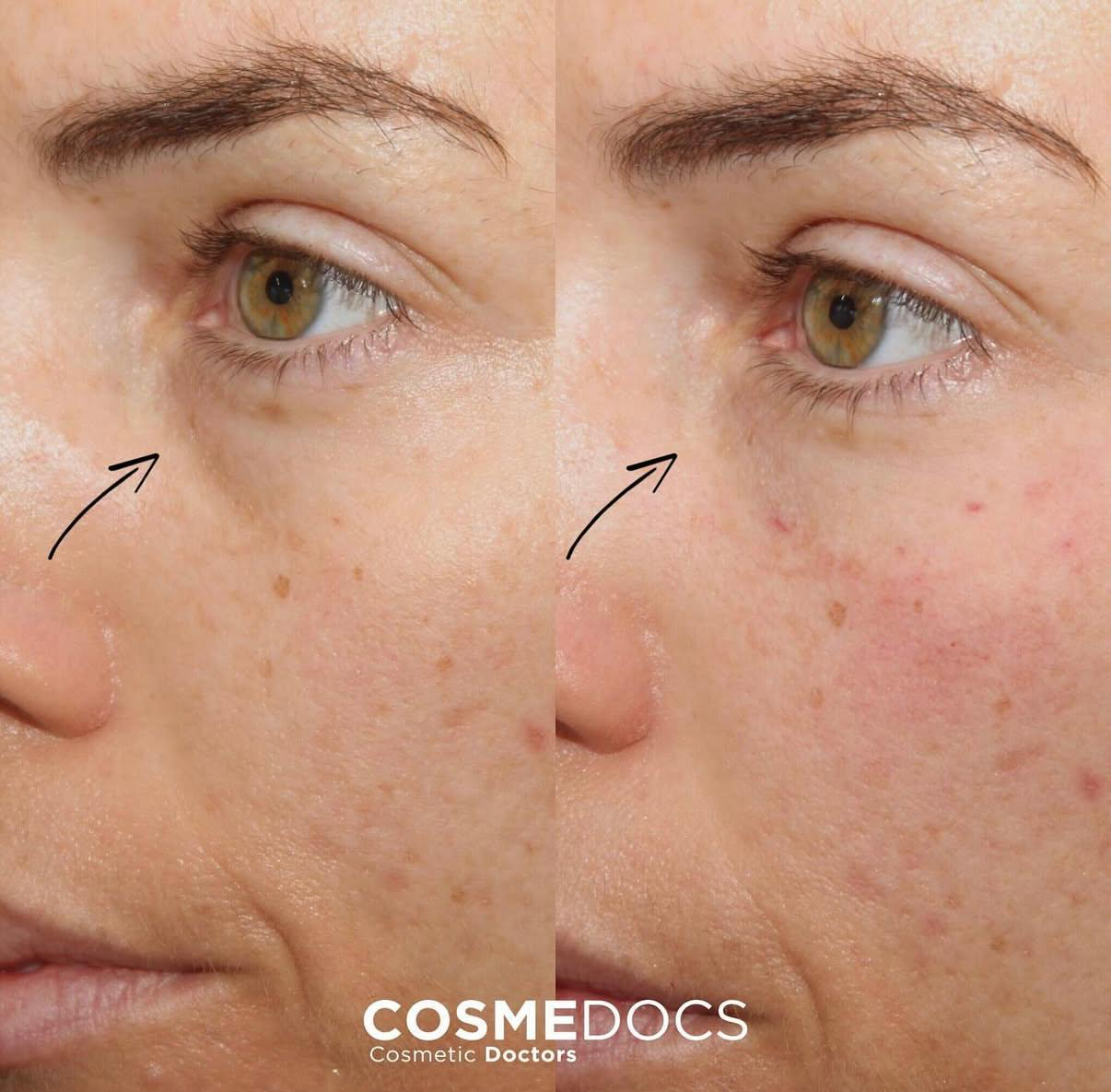 Close-up before and after tear trough filler showing subtle volume restoration and reduced under-eye hollowing
