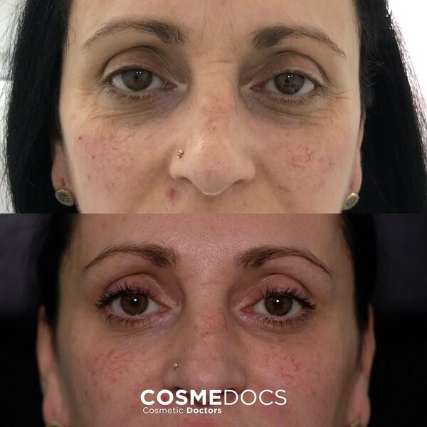 Before and after tear trough filler using Redensity 2 showing under-eye dark circle improvement with minimal entry points