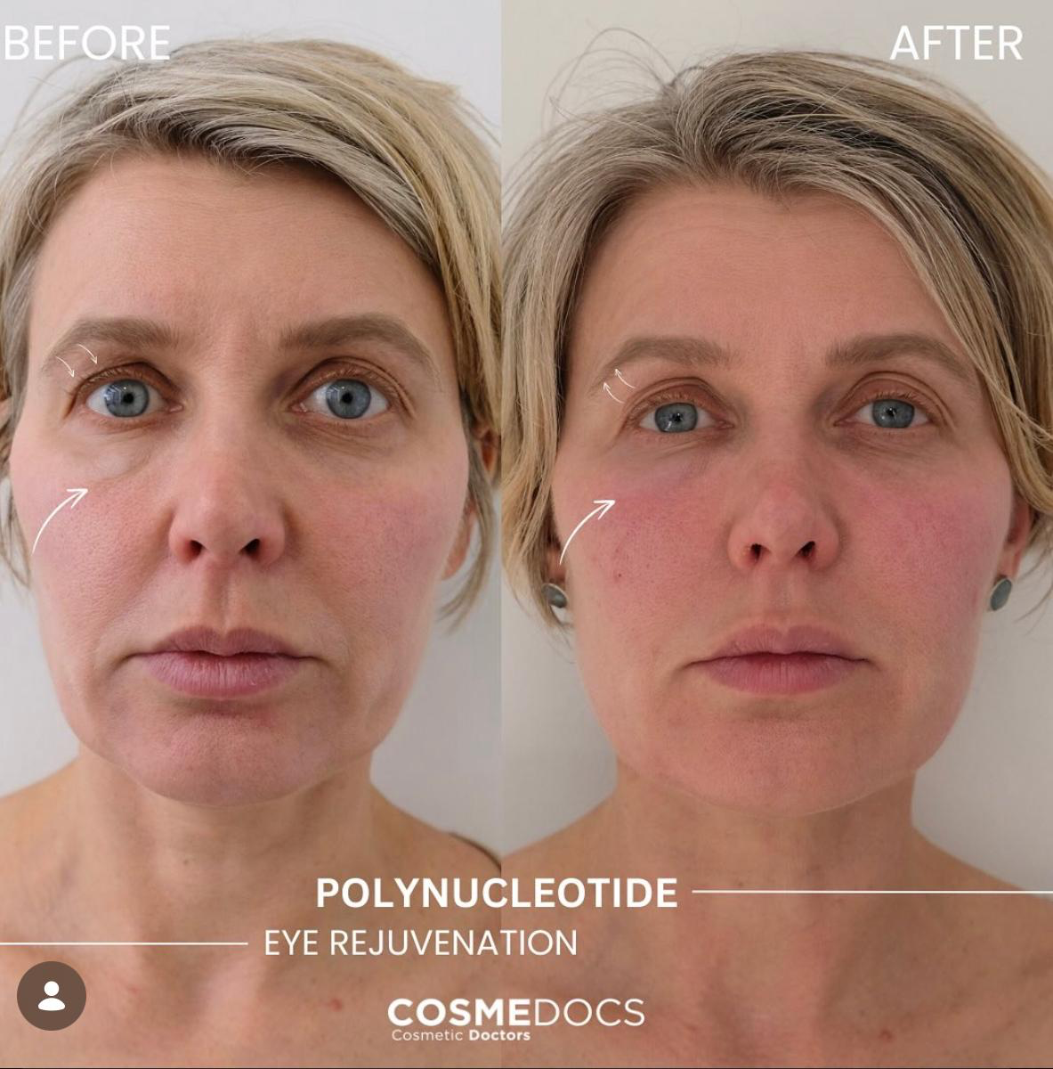Before and after polynucleotide eye rejuvenation showing improved skin quality and reduced under-eye hollowing