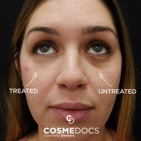 Tear trough filler treated versus untreated side comparison showing volume restoration on one side