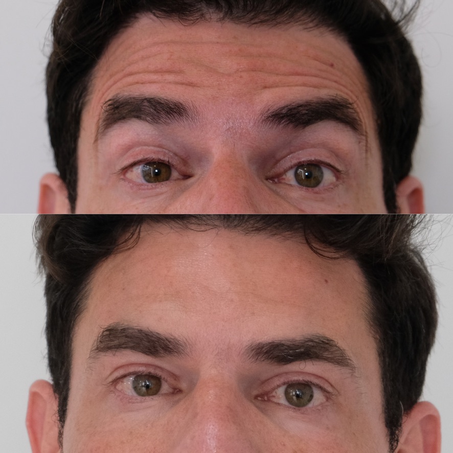 BroTox before and after — male forehead refreshed with flat masculine brow preserved, anti-wrinkle treatment Cosmedocs Harley Street London