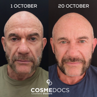 Male cheek filler before and after showing angular contour improvement