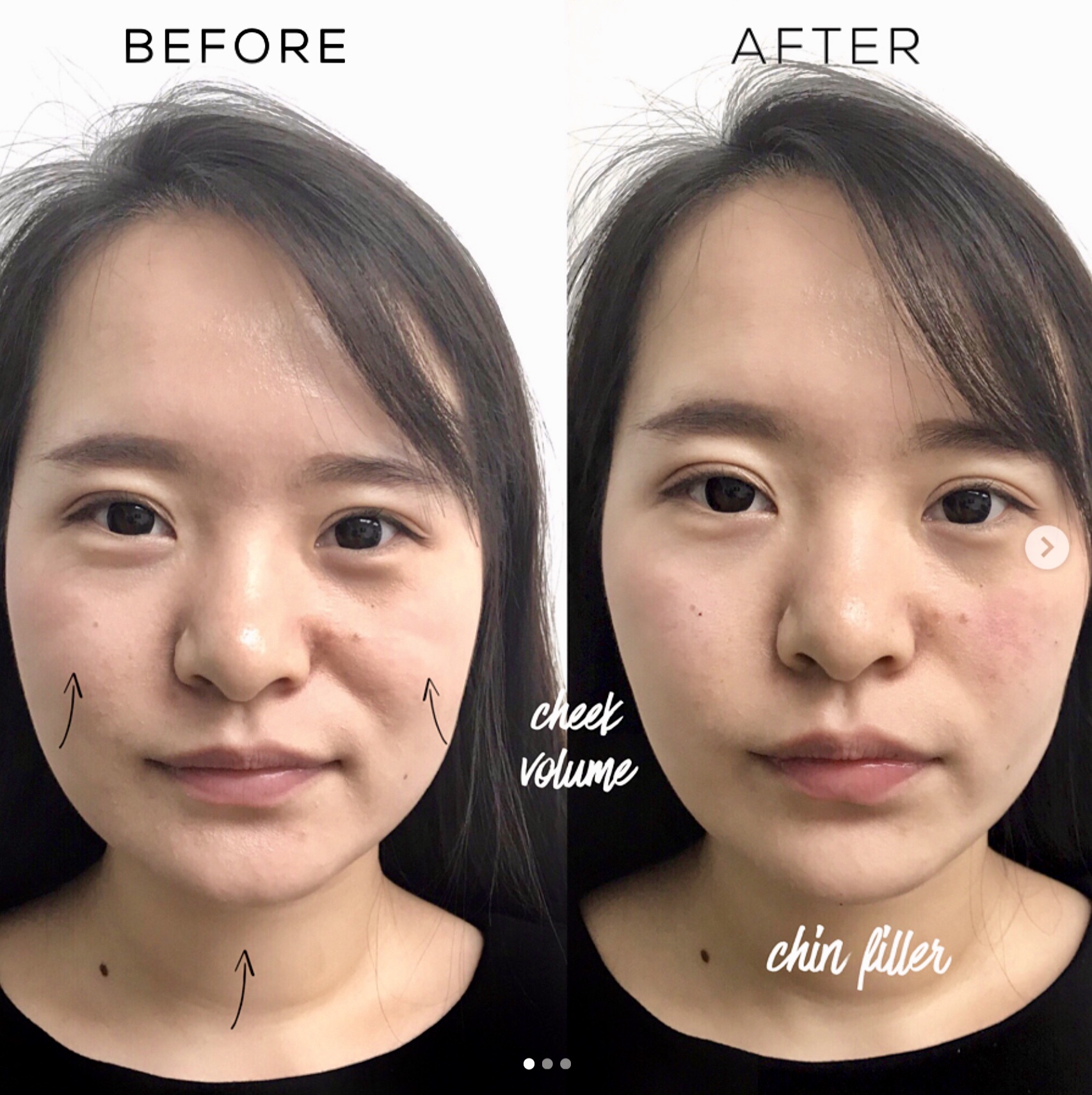 面颊与下巴填充 – 前后对比 – 哈雷街