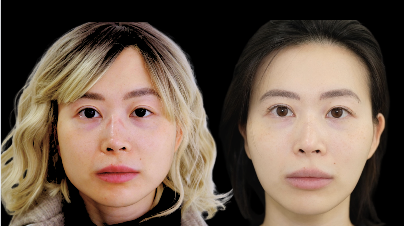 面部平衡改善 – 前后对比 – Cosmedocs 伦敦