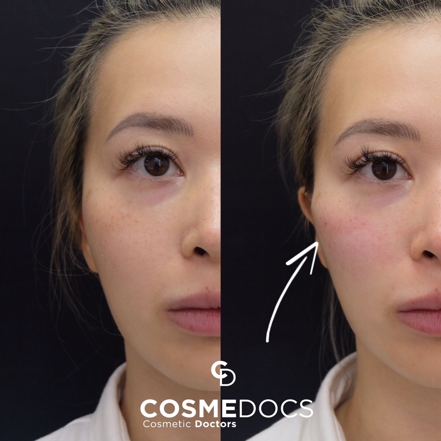 咬肌瘦脸 Botox – 前后对比 – Cosmedocs