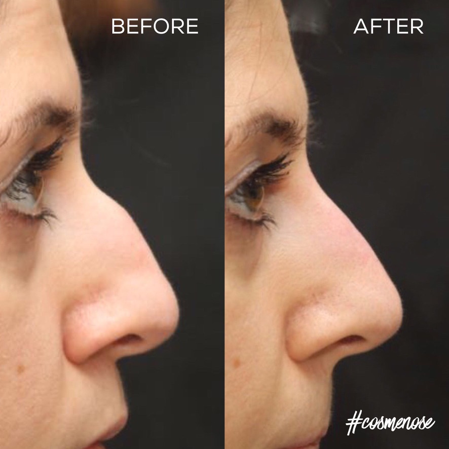 非手术鼻整形 – 前后对比 – Cosmedocs