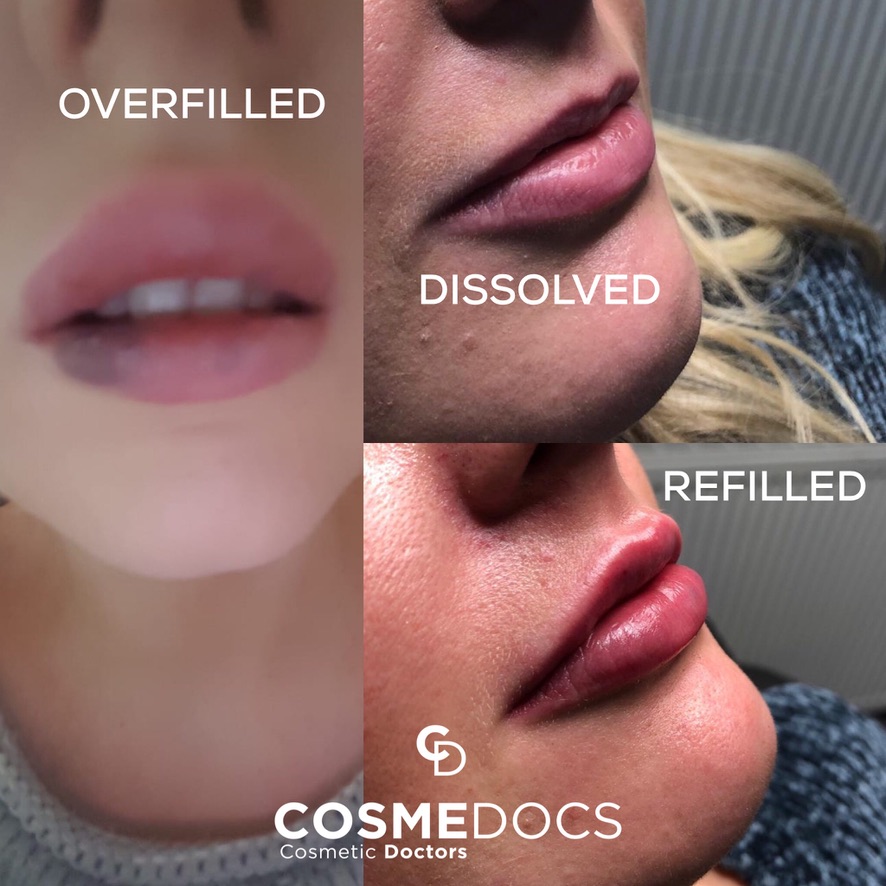 Cosmelips correction lèvres - Cosmedocs