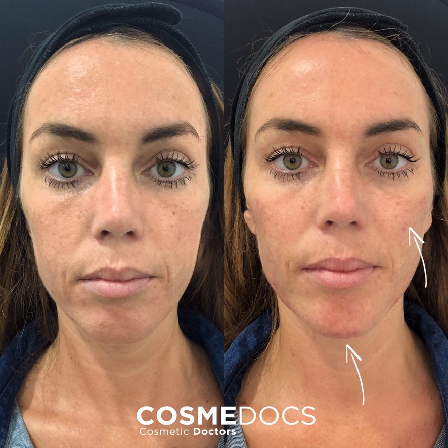 Before and after subtle anti-ageing treatment — wrinkle softening and natural facial rejuvenation with no visible signs of intervention