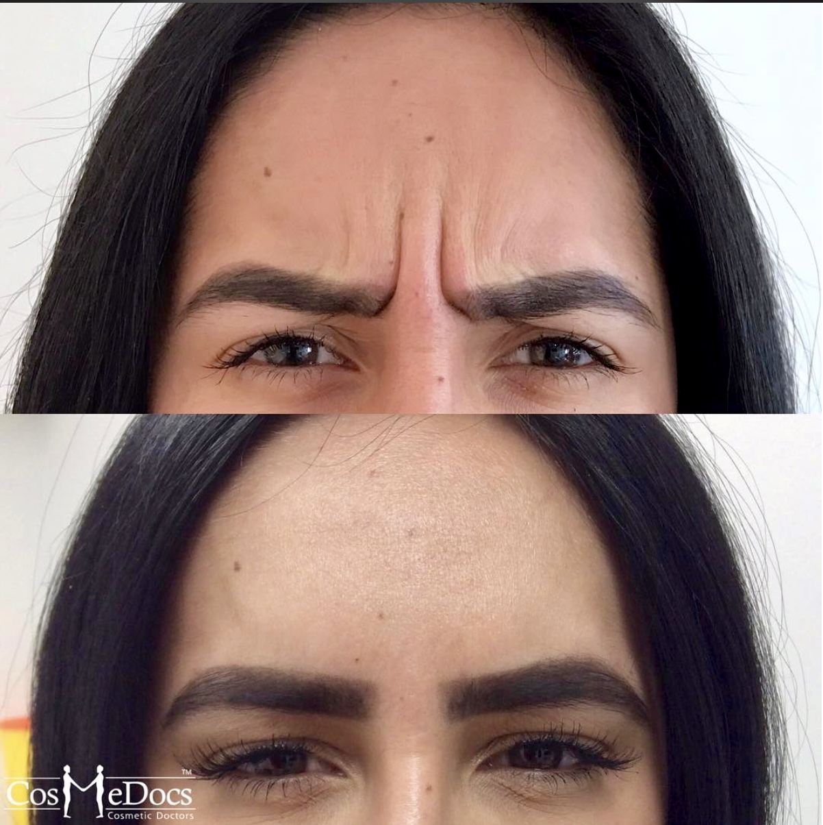 Frown line softening, before and after, Cosmedocs
