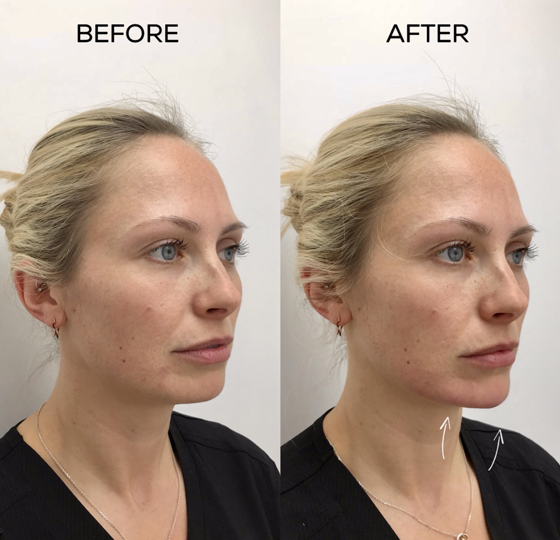 Chin Filler before and after, Cosmedocs
