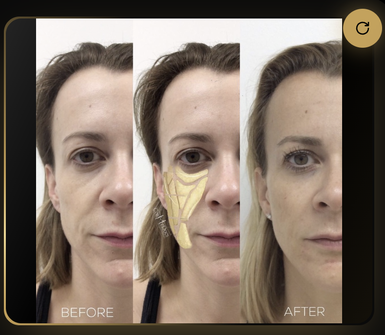 Liquid Facelift before and after, Cosmedocs