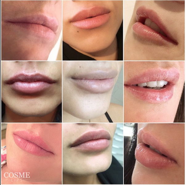Lip Filler before and after, Cosmedocs