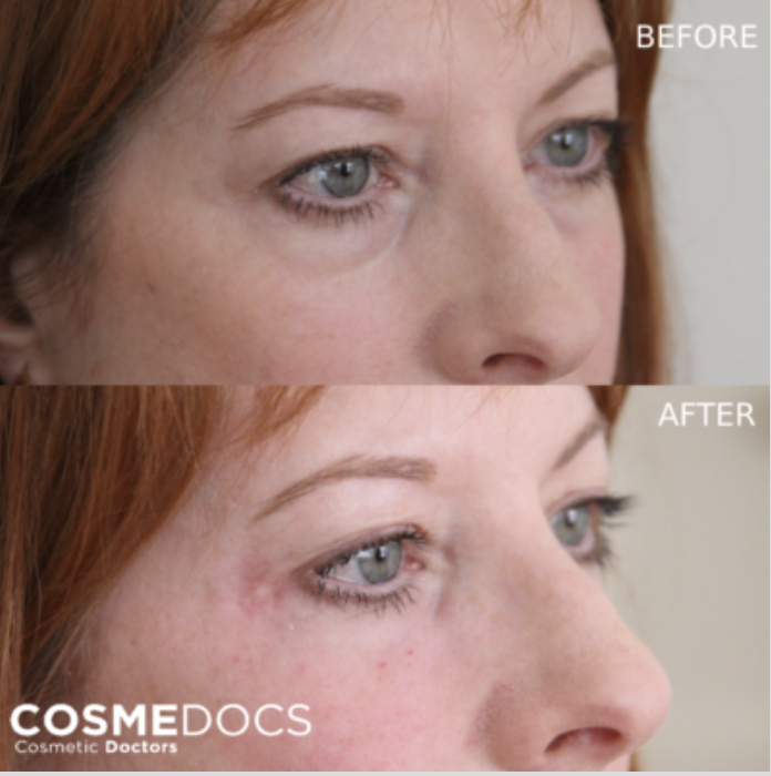 Tear Trough before and after, Cosmedocs