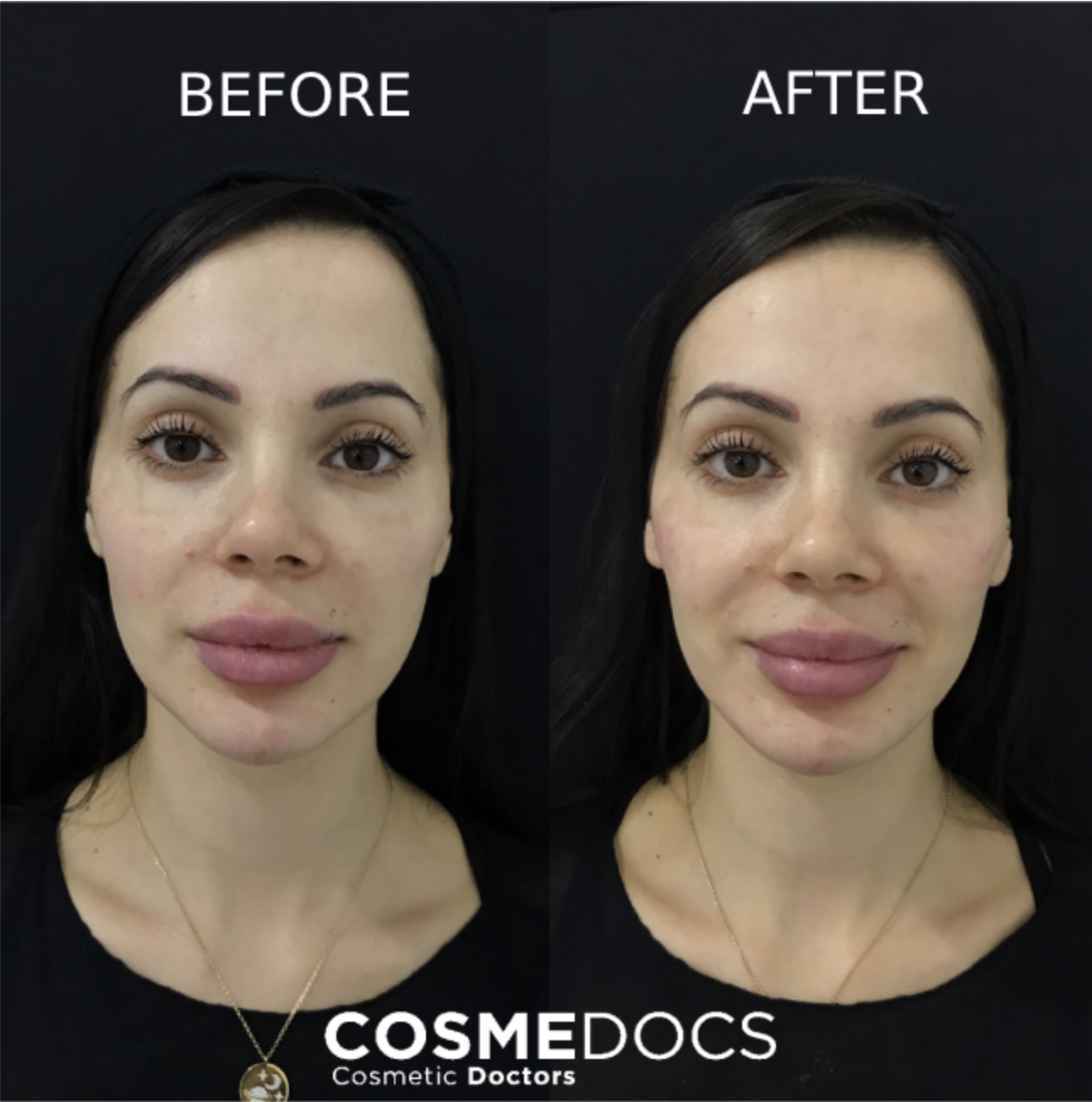 Before and after 2ml jawline filler showing defined sculpting