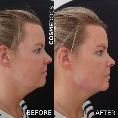 Before and after jawline filler showing masculine jaw enhancement