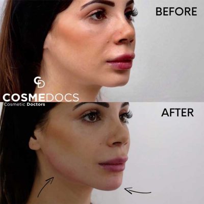 Before and after jawline contouring with dermal filler