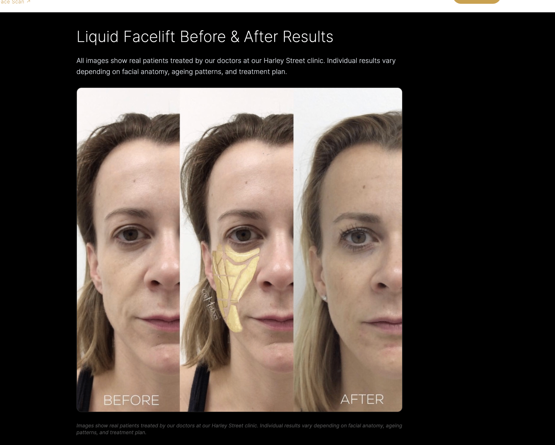 Liquid Facelift before and after, Cosmedocs