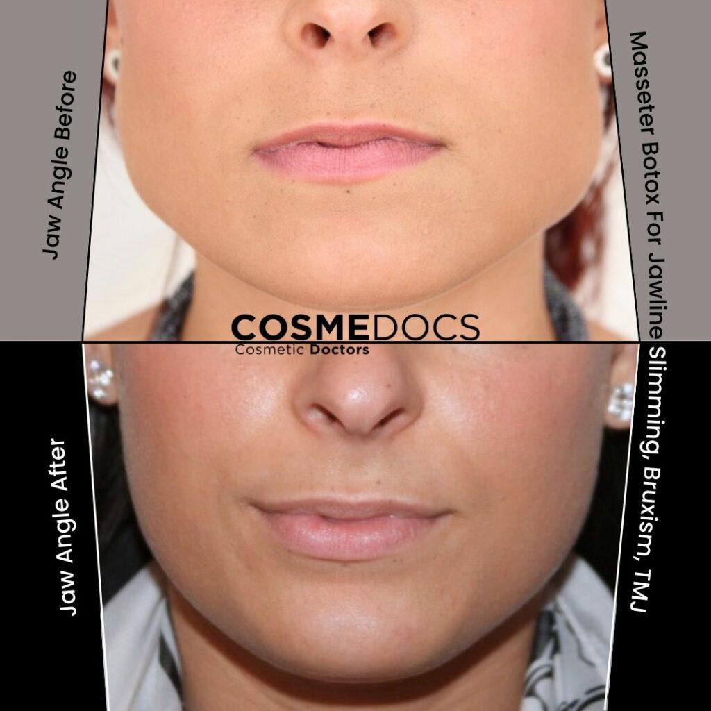 Before and after masseter Botox showing reduced jaw muscle bulk from angled view