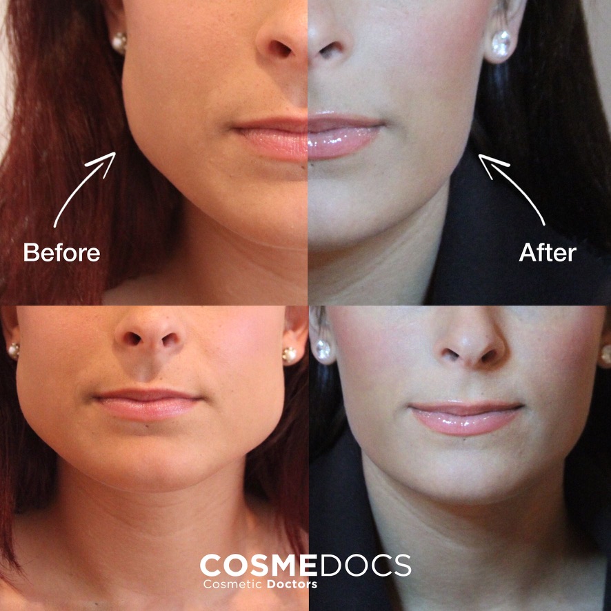 Masseter Botox before and after comparison from side and front profile