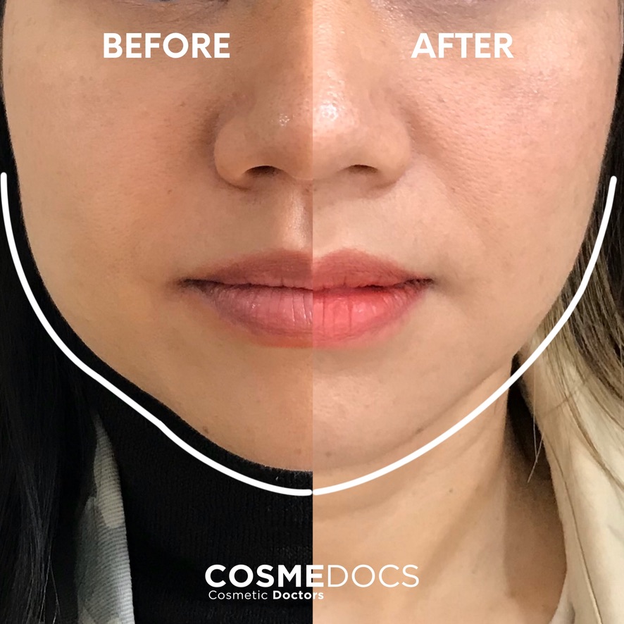 Before and after split view showing jawline slimming with masseter Botox