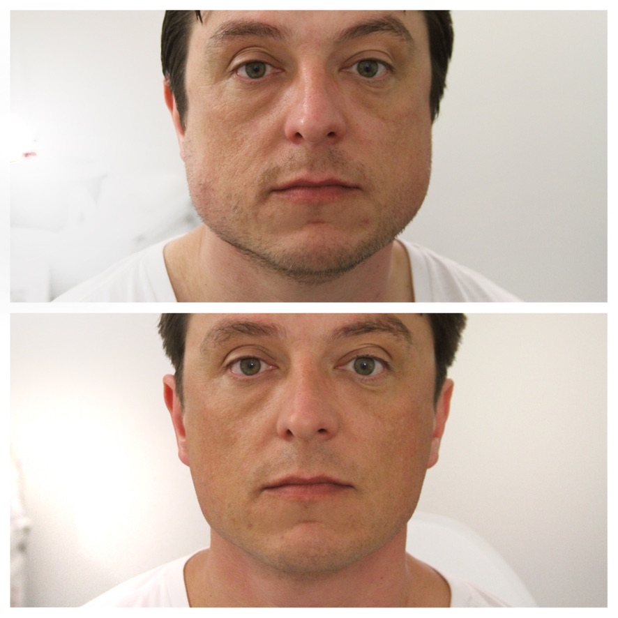 Before and after split view showing jawline slimming with masseter Botox