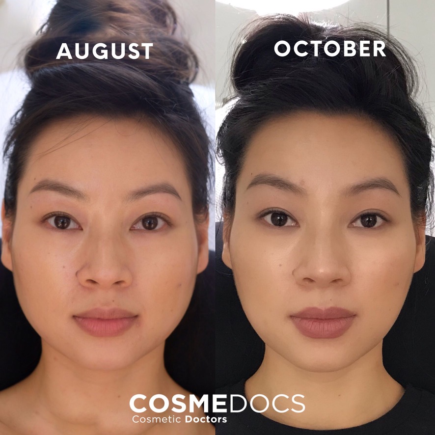 Masseter Botox progressive results showing facial slimming over time