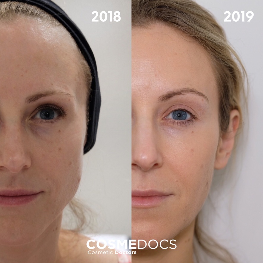 Long-term masseter Botox results with facial contouring improvement