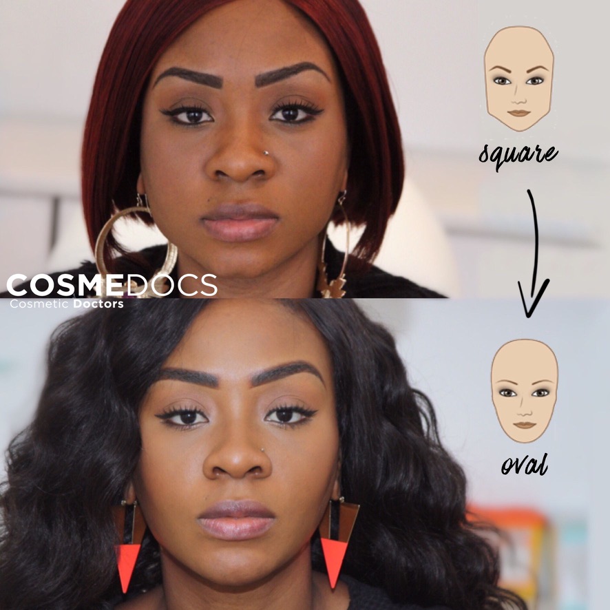 Before and after masseter Botox showing face shape transition from square to oval