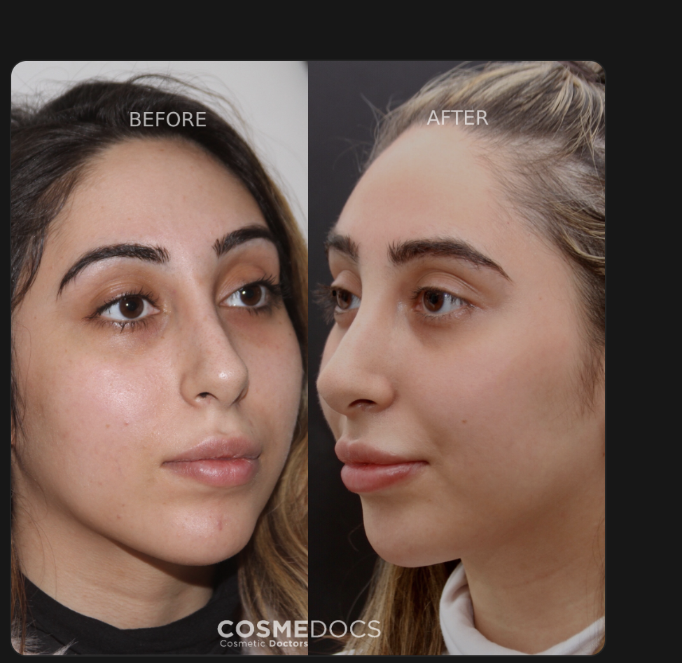 Real patient before and after masseter Botox: narrower lower face, refined jawline contour