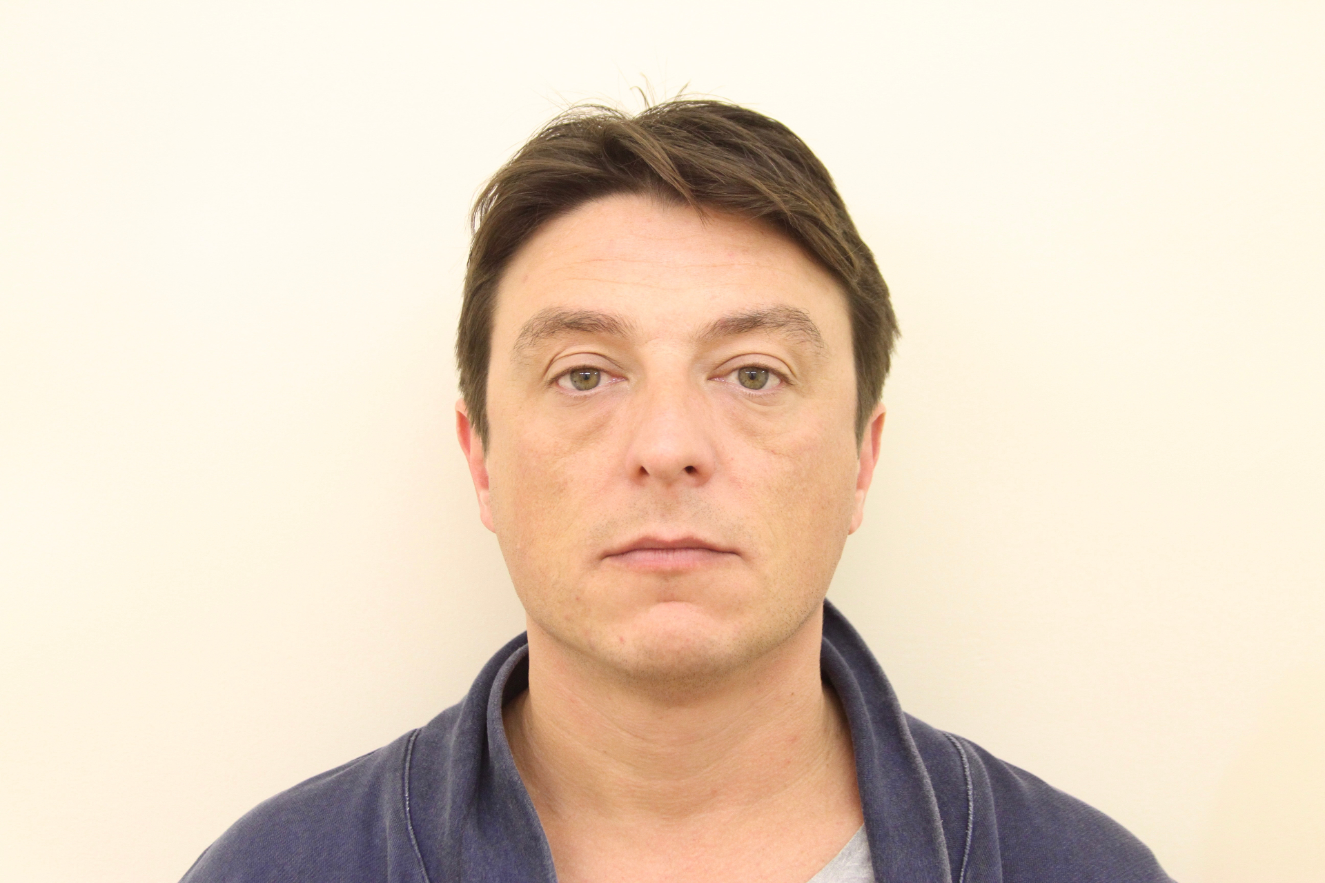 Same male patient one year after a third masseter Botox treatment at CosmeDocs — maintained slimmer jaw and refined lower face
