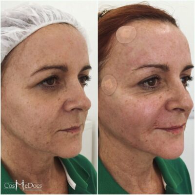 PDO thread face lift transformation performed in London