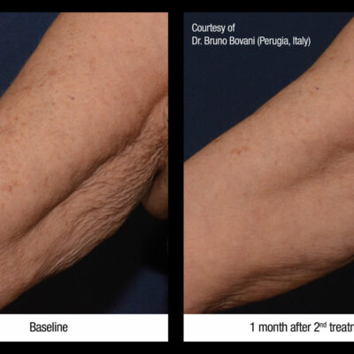 Profhilo arm treatment before and after