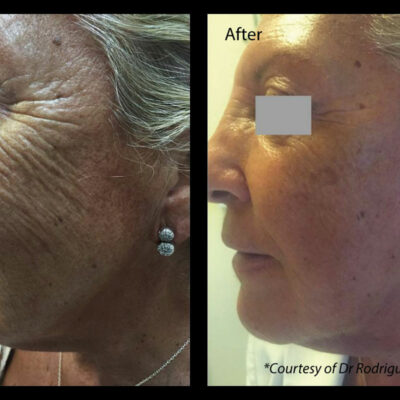 Profhilo cheek treatment before and after