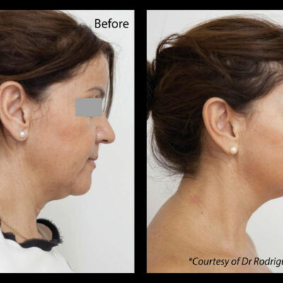 Profhilo face treatment before and after results