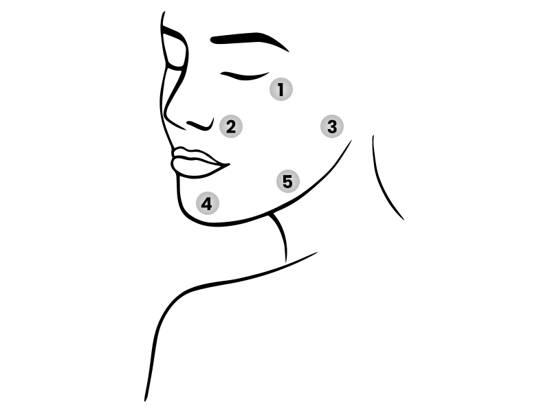 Profhilo BAP injection points on face
