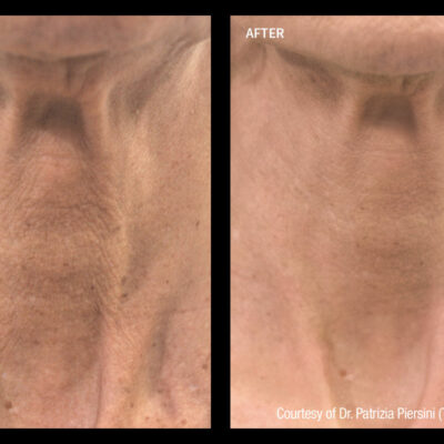 Profhilo neck treatment enhanced skin texture