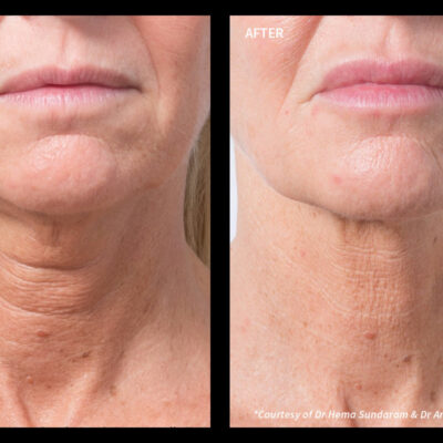 Profhilo neck treatment before and after
