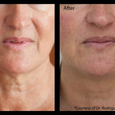 Profhilo neck and lower face treatment