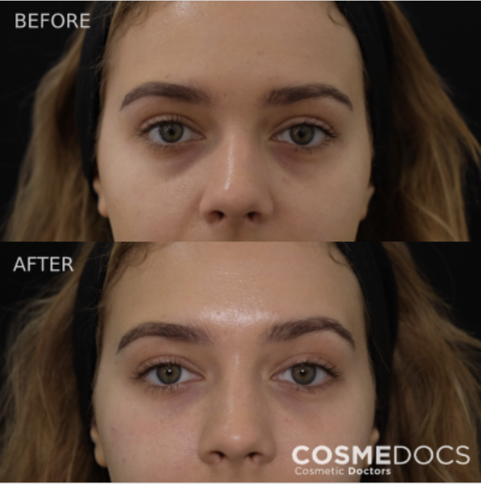 Before and after tear trough filler showing close-up under-eye dark circle correction