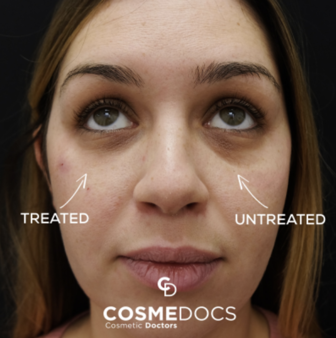Treated versus untreated side comparison showing tear trough filler results