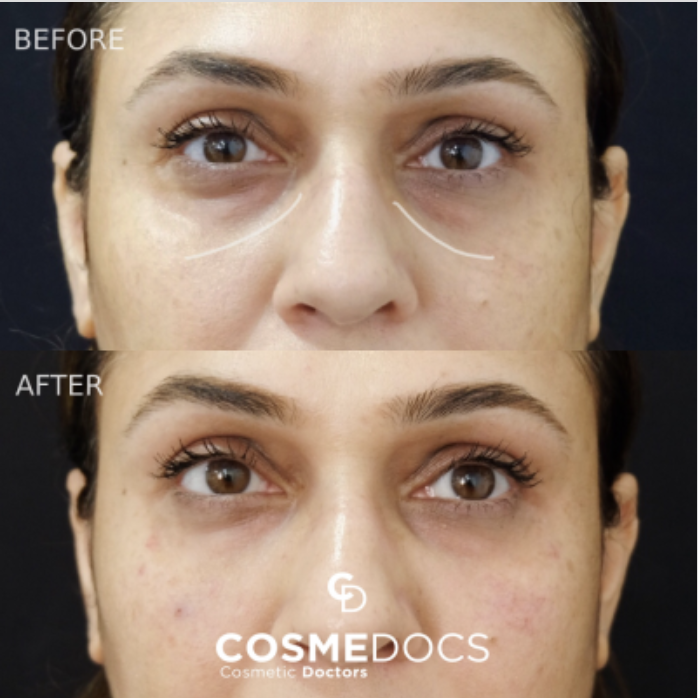 Before and after tear trough filler showing under-eye rejuvenation and hollow correction