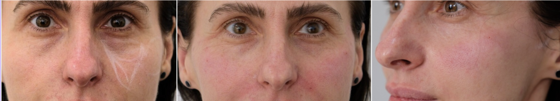 Real patient under-eye assessment trio — front, frontal close-up, and three-quarter view — tear trough filler consultation at Cosmedocs Harley Street