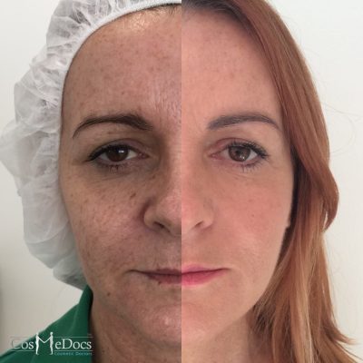 PDO thread lift before and after — combination treatment with skin rejuvenation