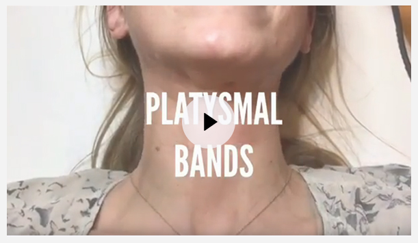 Botox Treatment for Platysmal Neck Bands