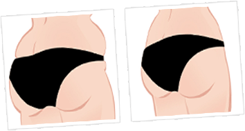 Buttock Sketch before and after