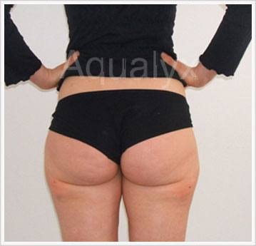 Aqualyx Non-Invasive After treatment picture