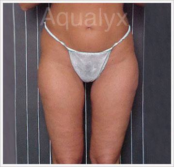 Aqualyx belly after treatment