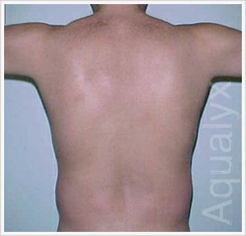 Before Aqualyx Fat Dissolving Injection