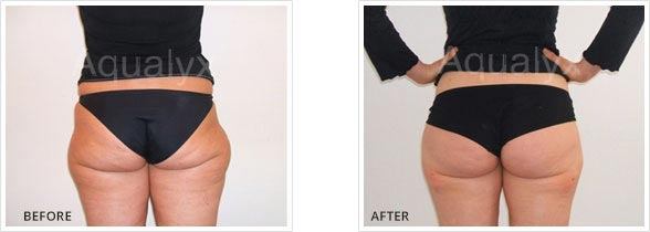 Aqualyx Buttock Treatment before and After