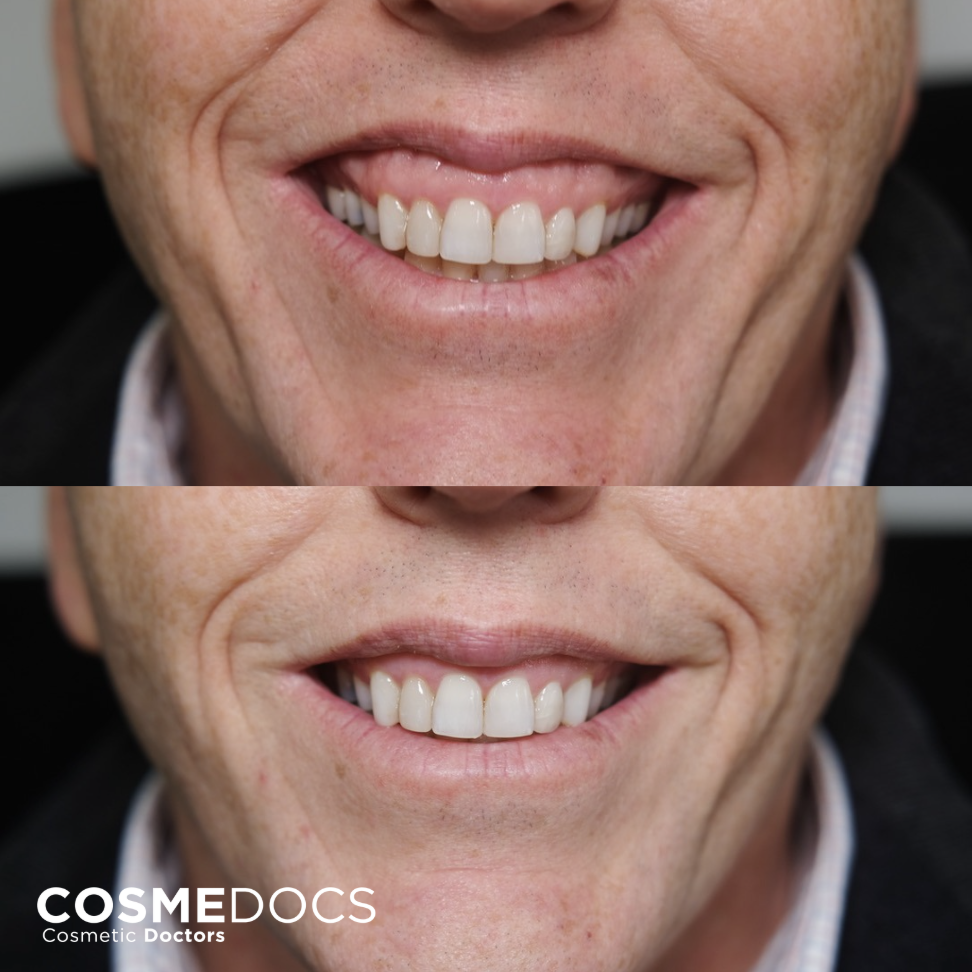 Gummy smile correction before and after Botox treatment